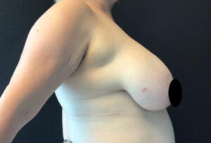 Breast Reduction