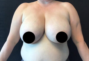 Breast Reduction