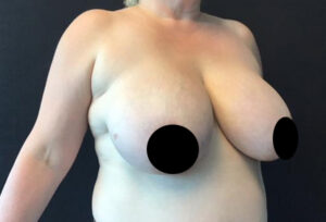 Breast Reduction