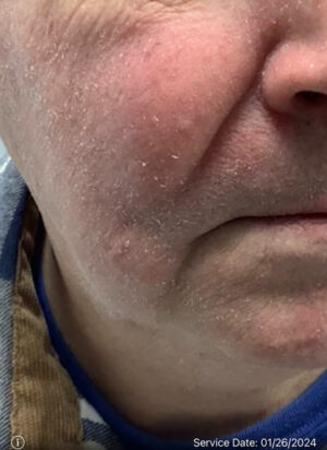 Basal Cell Carcinoma