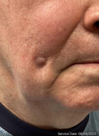 Basal Cell Carcinoma