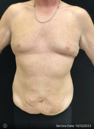 Gynecomastia