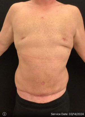 Gynecomastia