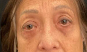 Upper Eyelid Blepharoplasty